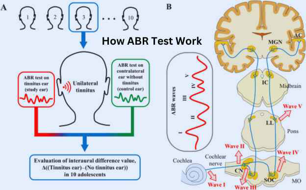 abr